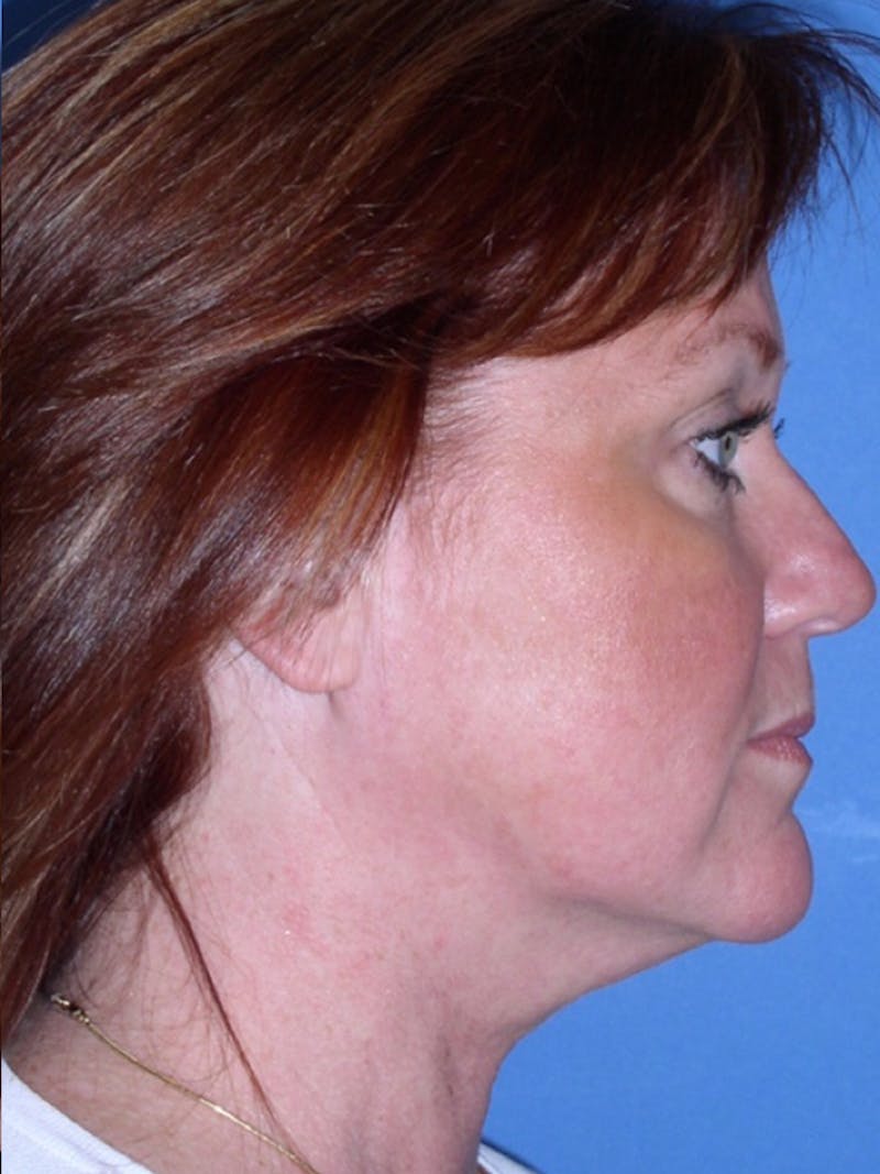 Deep Plane Lower Face and Neck Lift Before & After Gallery - Patient 177269692 - Image 5