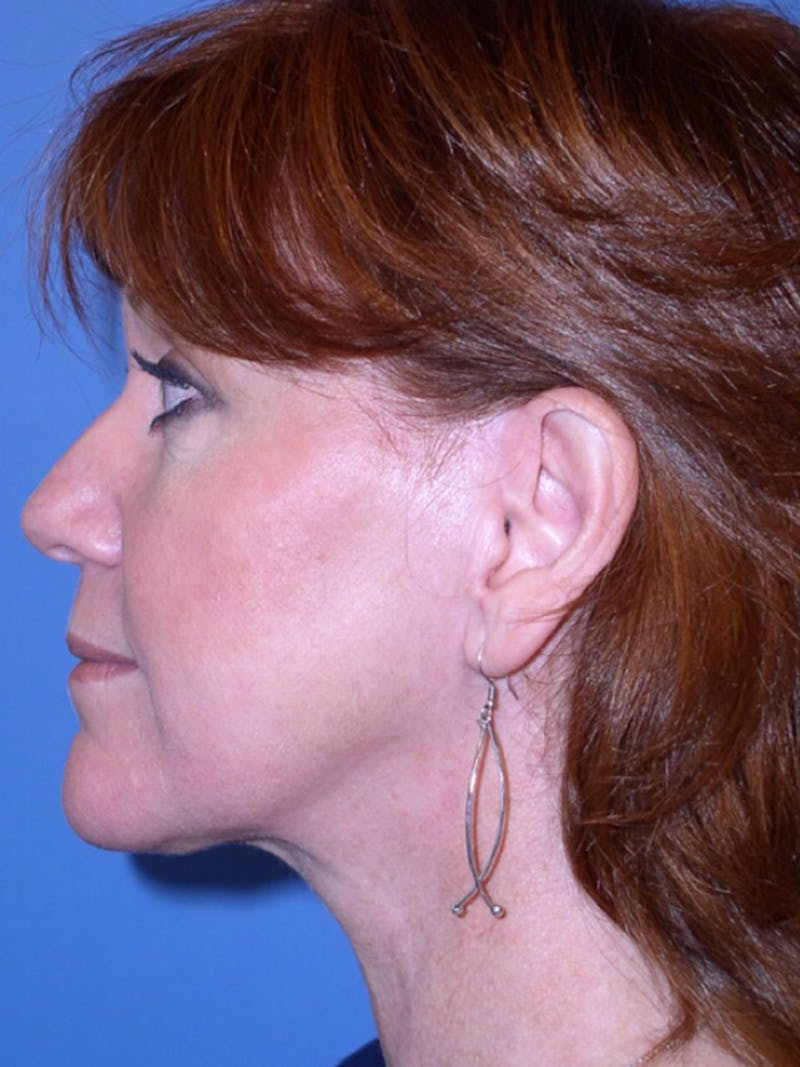 Deep Plane Lower Face and Neck Lift Before & After Gallery - Patient 177269692 - Image 8