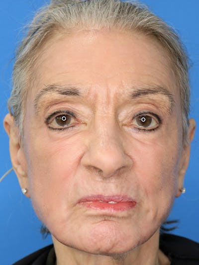 C02 Laser Resurfacing Before & After Gallery - Patient 179445667 - Image 2