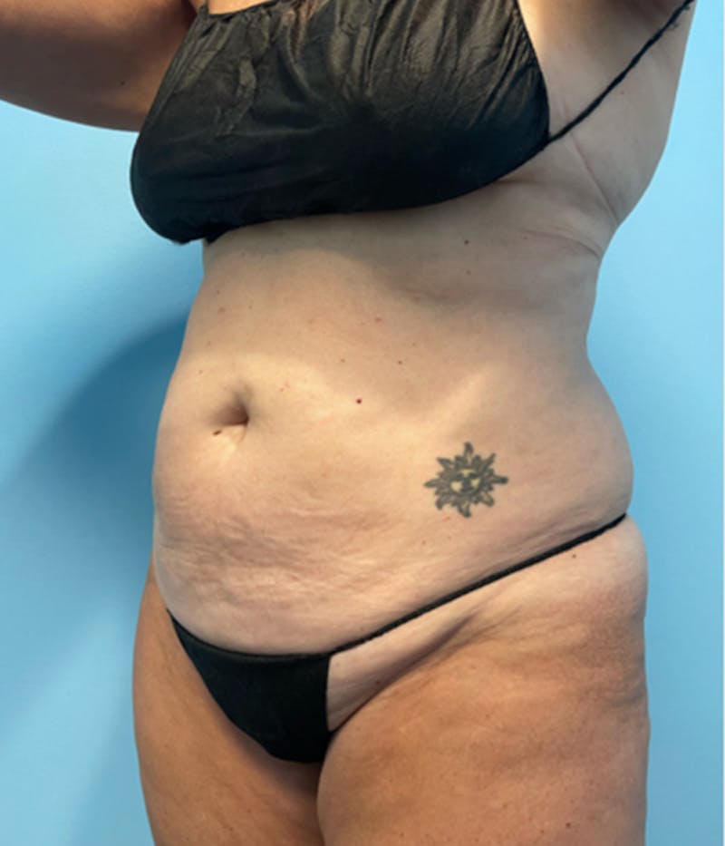CoolSculpting Before & After Gallery - Patient 179447475 - Image 1