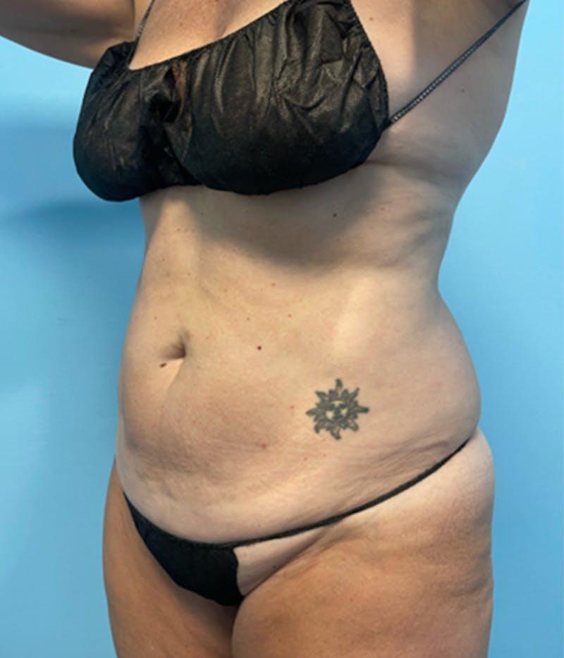 CoolSculpting Before & After Gallery - Patient 179447475 - Image 2