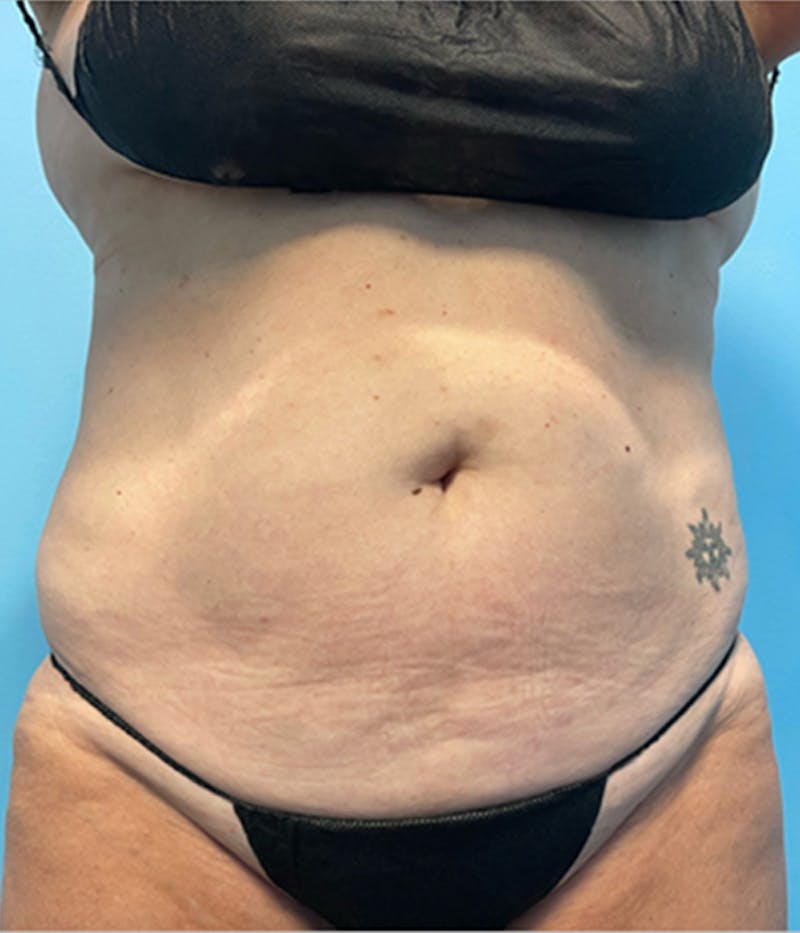 CoolSculpting Before & After Gallery - Patient 179447475 - Image 3