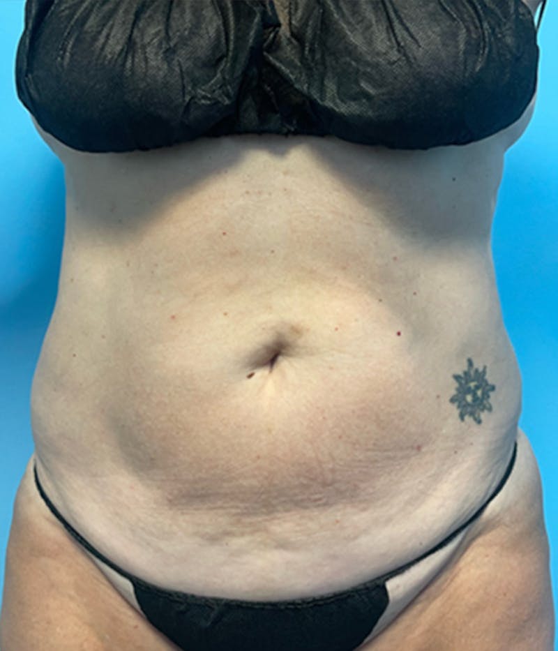 CoolSculpting Before & After Gallery - Patient 179447475 - Image 4