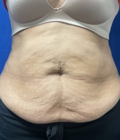 CoolSculpting Before & After Gallery - Patient 179447474 - Image 1