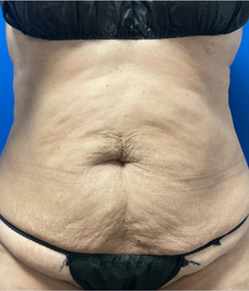 CoolSculpting Before & After Gallery - Patient 179447474 - Image 2