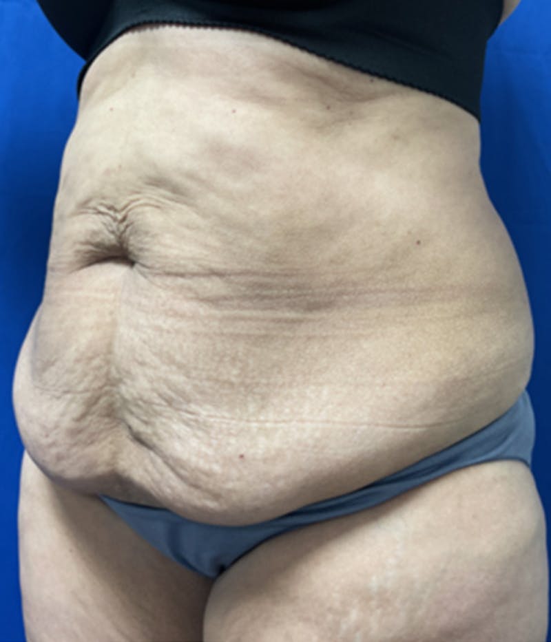 CoolSculpting Before & After Gallery - Patient 179447474 - Image 3