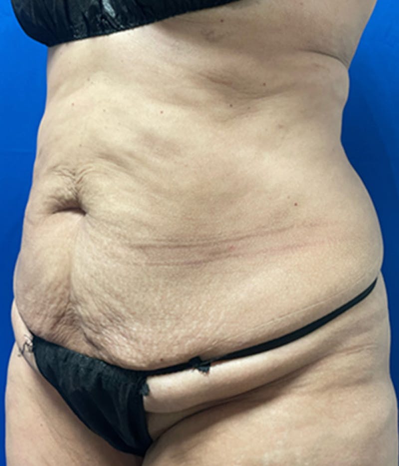 CoolSculpting Before & After Gallery - Patient 179447474 - Image 4