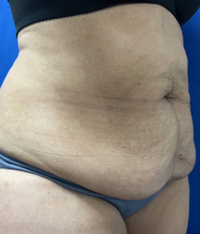 CoolSculpting Before & After Gallery - Patient 179447474 - Image 5