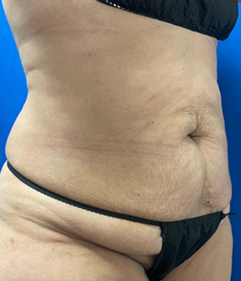 CoolSculpting Before & After Gallery - Patient 179447474 - Image 6