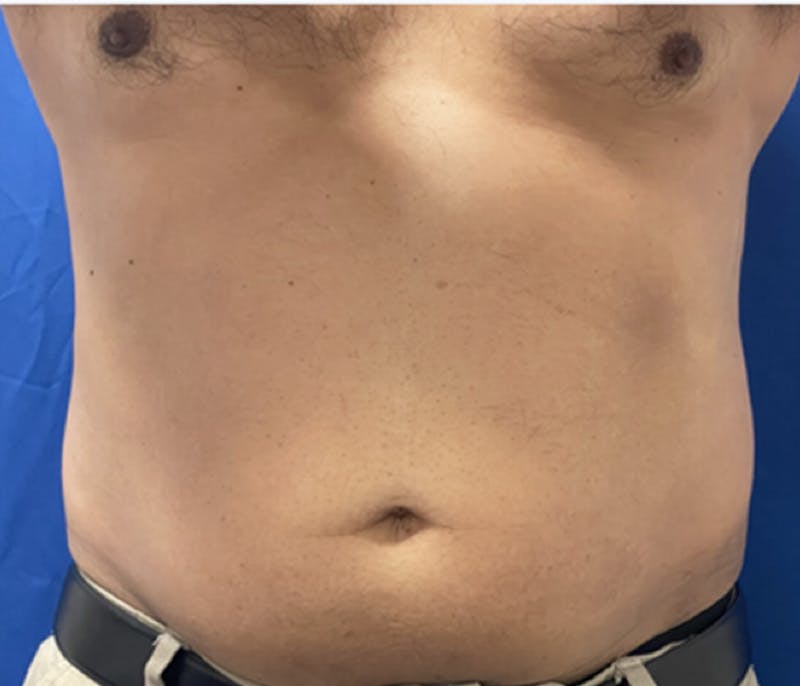 CoolSculpting Before & After Gallery - Patient 179447478 - Image 1