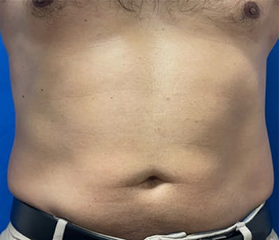CoolSculpting Before & After Gallery - Patient 179447478 - Image 2