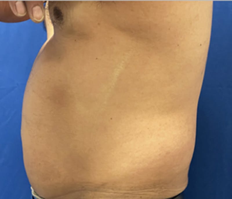 CoolSculpting Before & After Gallery - Patient 179447478 - Image 3