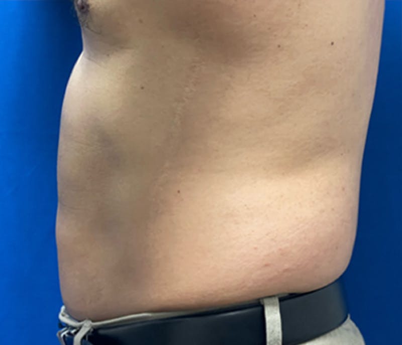 CoolSculpting Before & After Gallery - Patient 179447478 - Image 4