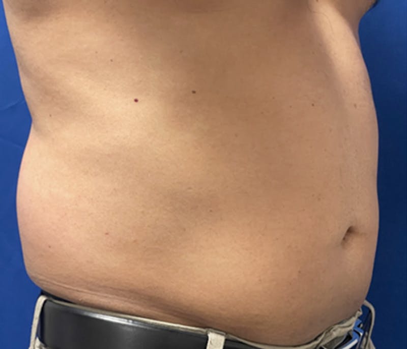 CoolSculpting Before & After Gallery - Patient 179447478 - Image 5