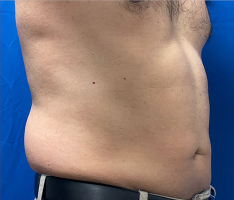 CoolSculpting Before & After Gallery - Patient 179447478 - Image 6