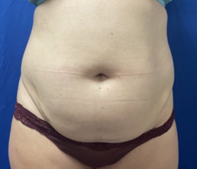 CoolSculpting Before & After Gallery - Patient 179447481 - Image 1