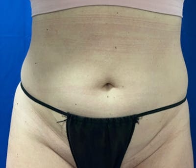 CoolSculpting Before & After Gallery - Patient 179447481 - Image 2