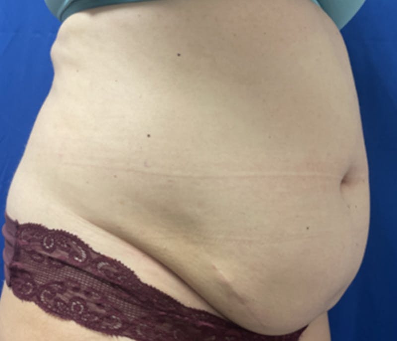 CoolSculpting Before & After Gallery - Patient 179447481 - Image 3