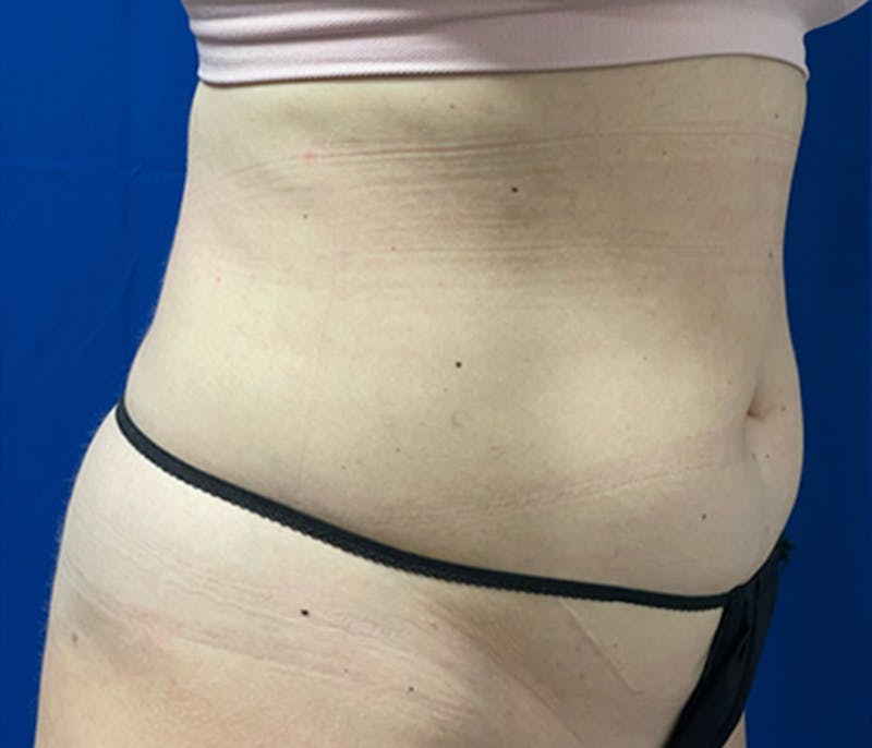 CoolSculpting Before & After Gallery - Patient 179447481 - Image 4