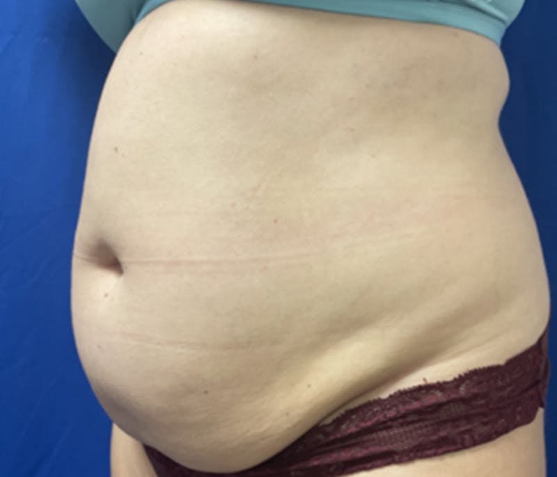 CoolSculpting Before & After Gallery - Patient 179447481 - Image 5