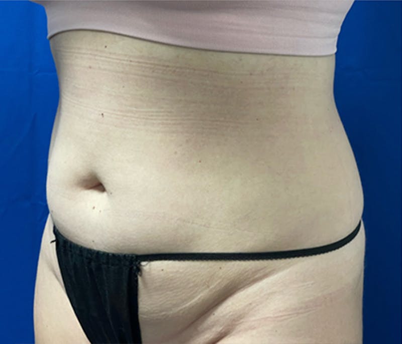 CoolSculpting Before & After Gallery - Patient 179447481 - Image 6