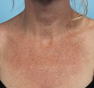 IPL and Pigment Therapy Before & After Gallery - Patient 179704014 - Image 1