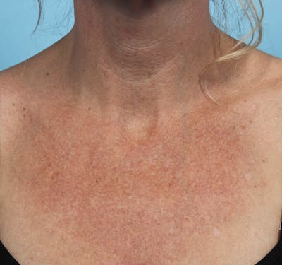 IPL and Pigment Therapy Before & After Gallery - Patient 179704014 - Image 1