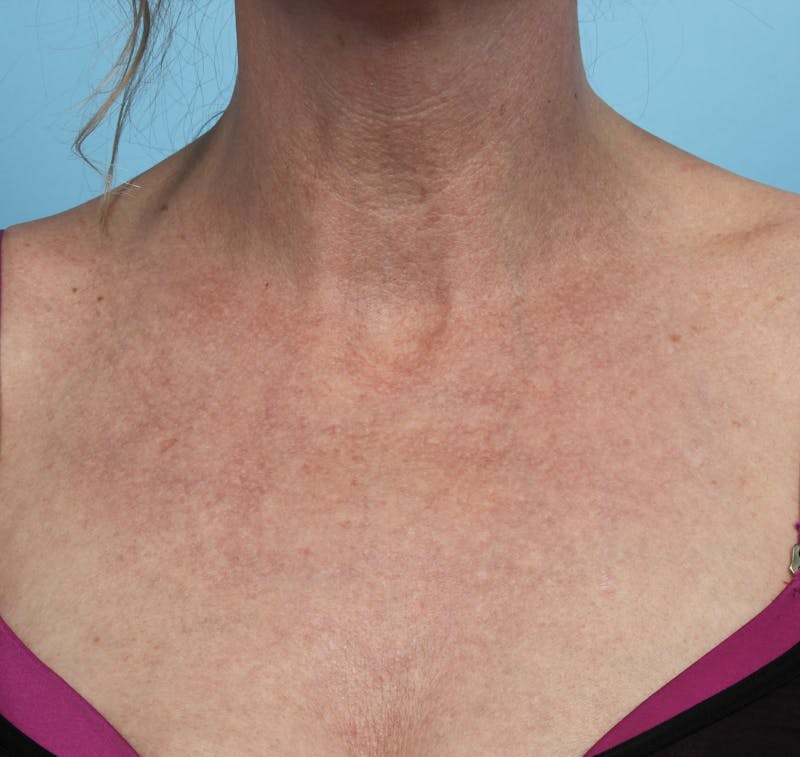 IPL and Pigment Therapy Before & After Gallery - Patient 179704014 - Image 2