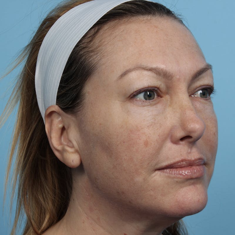 IPL and Pigment Therapy Before & After Gallery - Patient 179704015 - Image 3