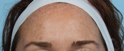 IPL and Pigment Therapy Before & After Gallery - Patient 179704021 - Image 1