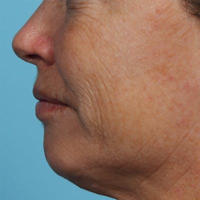 IPL and Pigment Therapy Before & After Gallery - Patient 179727320 - Image 1