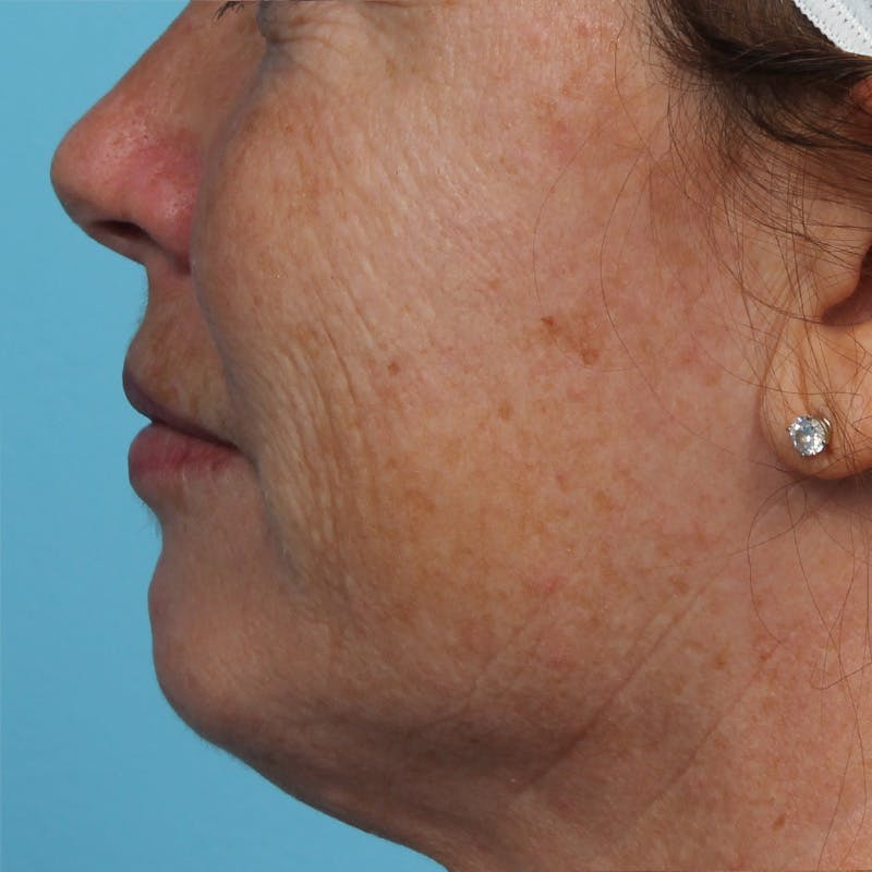 IPL and Pigment Therapy Before & After Gallery - Patient 179727320 - Image 2