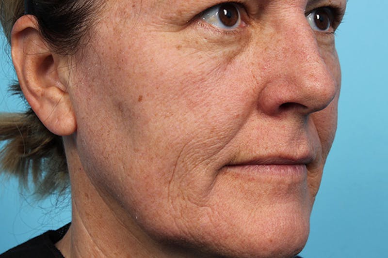 IPL and Pigment Therapy Before & After Gallery - Patient 179727321 - Image 3