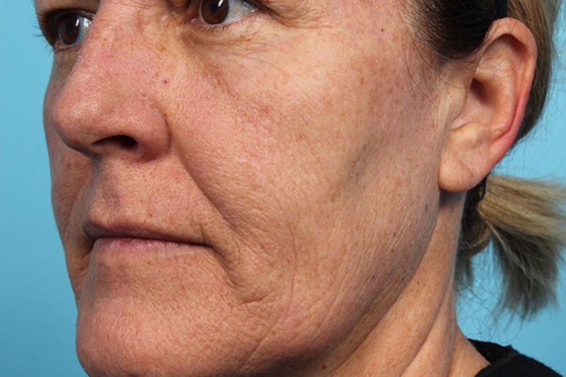 IPL and Pigment Therapy Before & After Gallery - Patient 179727321 - Image 5
