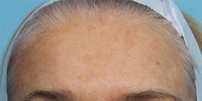 IPL and Pigment Therapy Before & After Gallery - Patient 179727323 - Image 2