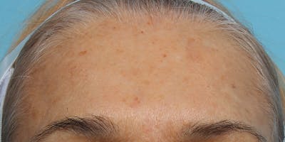 IPL and Pigment Therapy Before & After Gallery - Patient 179727323 - Image 1