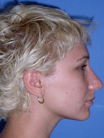 Rhinoplasty Before & After Gallery - Patient 179728261 - Image 1