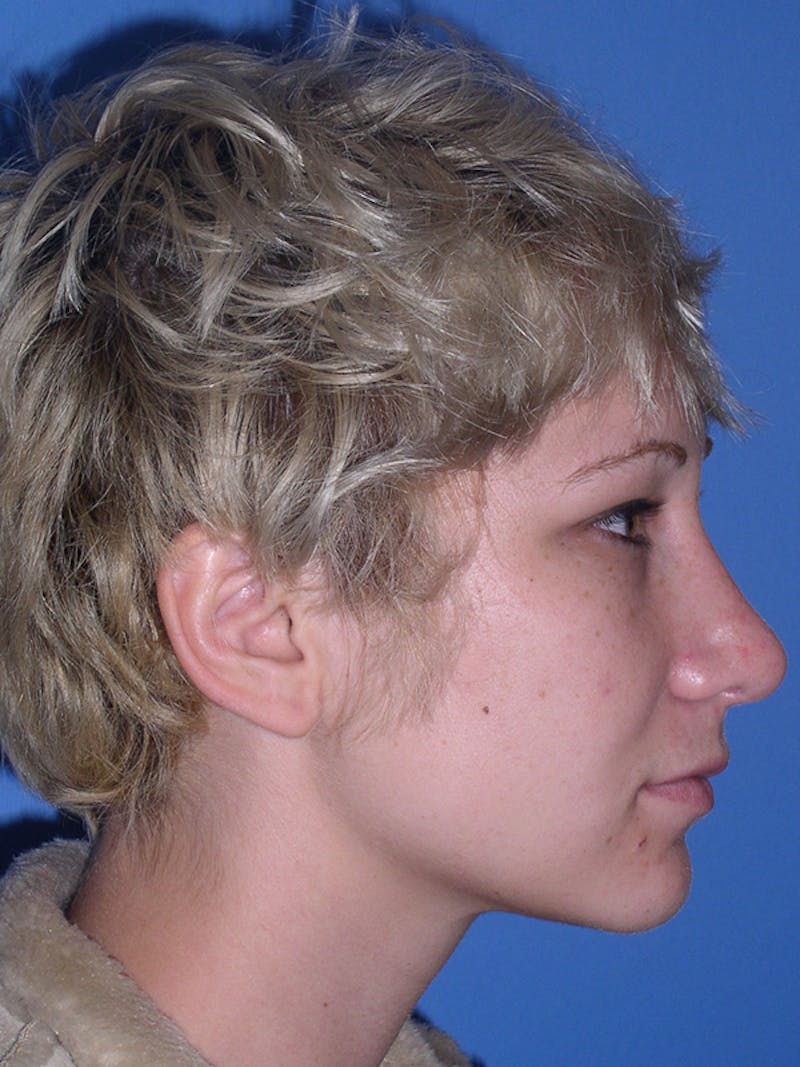 Rhinoplasty Before & After Gallery - Patient 179728261 - Image 2