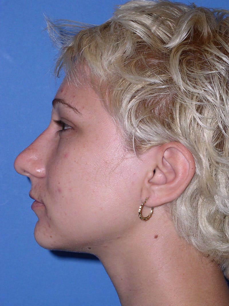 Rhinoplasty Before & After Gallery - Patient 179728261 - Image 5