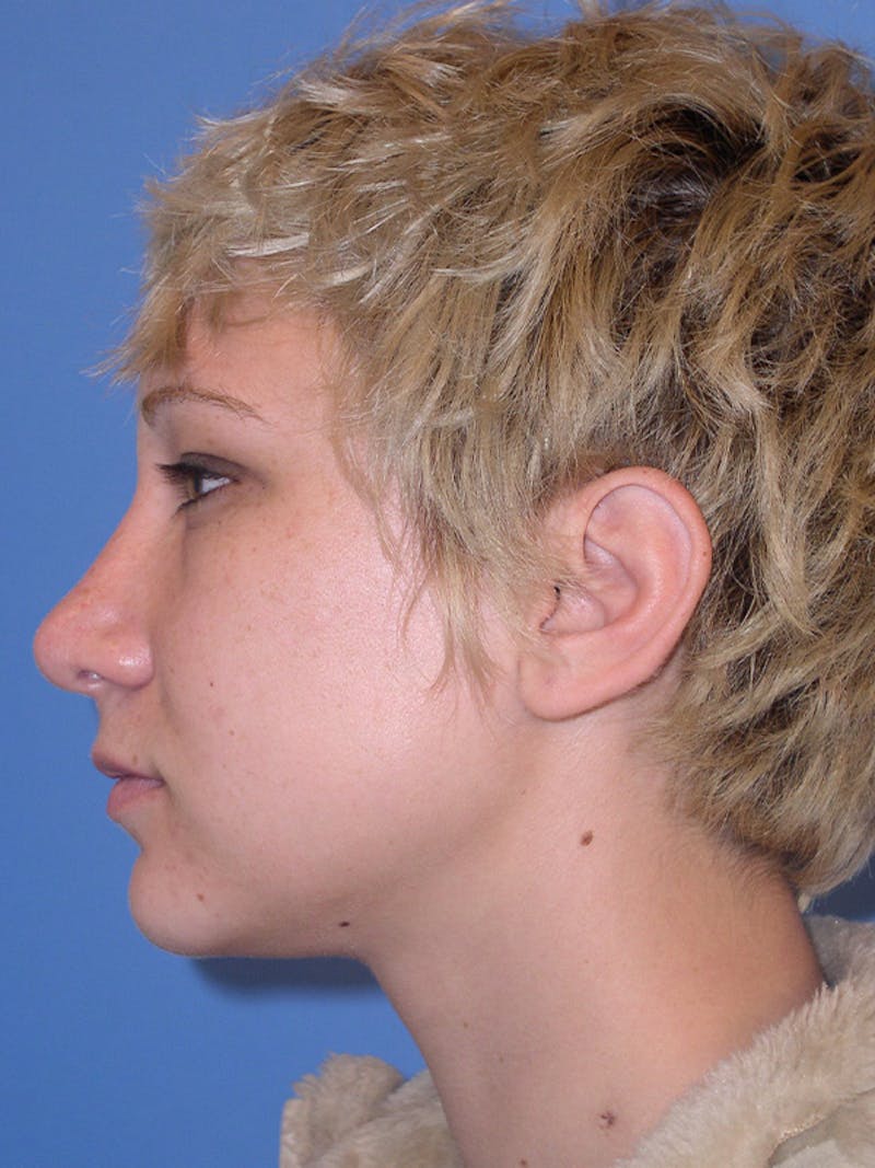 Rhinoplasty Before & After Gallery - Patient 179728261 - Image 6