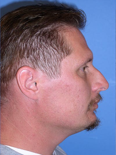 Rhinoplasty Before & After Gallery - Patient 179728260 - Image 1