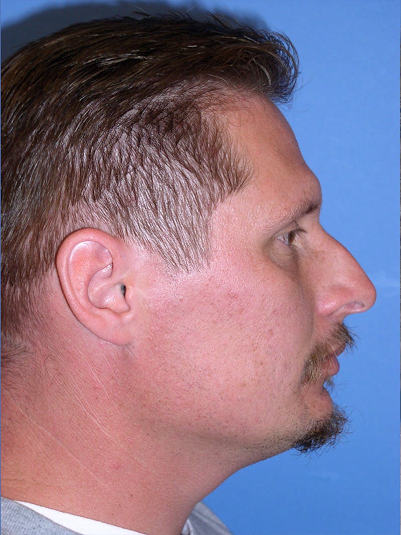 Rhinoplasty Before & After Gallery - Patient 179728260 - Image 1