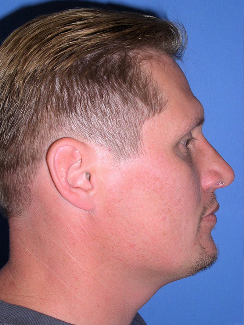 Rhinoplasty Before & After Gallery - Patient 179728260 - Image 2