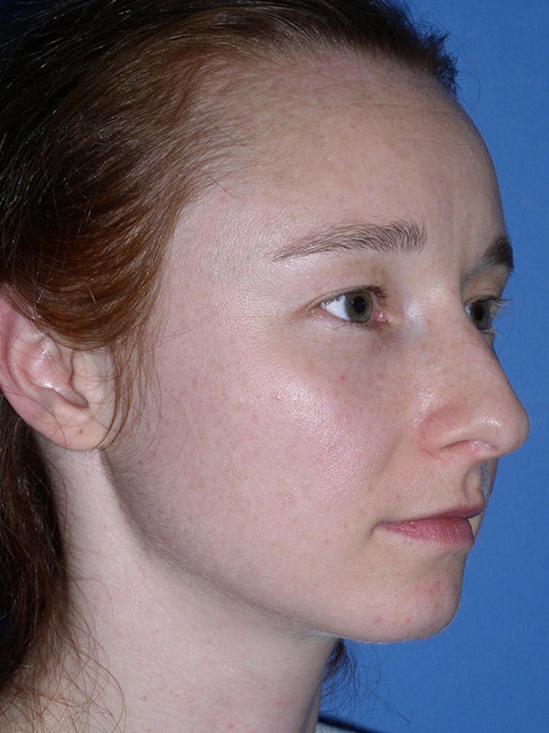 Rhinoplasty Before & After Gallery - Patient 179729367 - Image 3