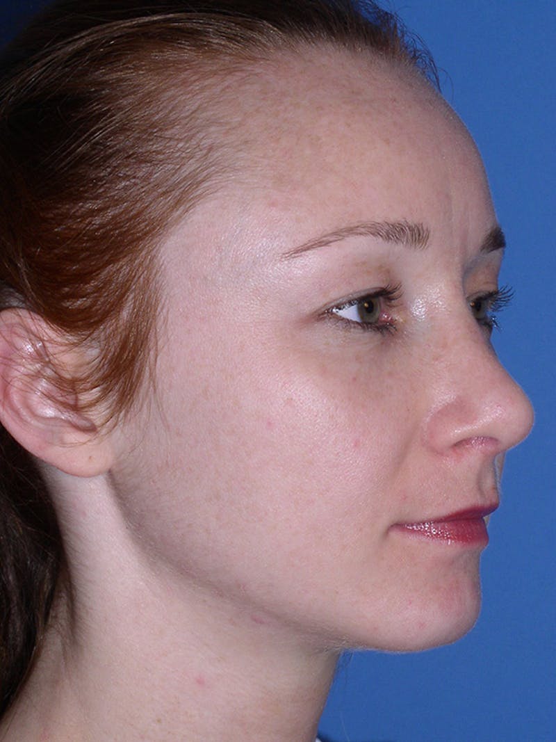 Rhinoplasty Before & After Gallery - Patient 179729367 - Image 4