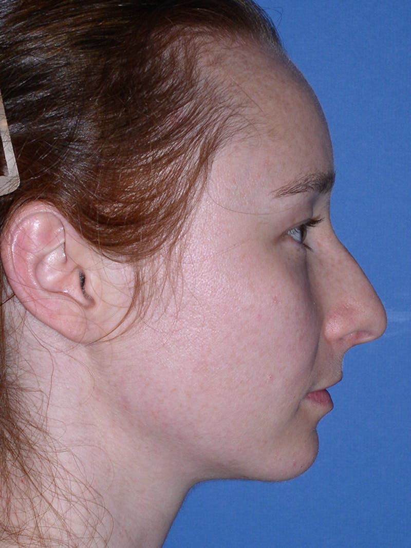 Rhinoplasty Before & After Gallery - Patient 179729367 - Image 5