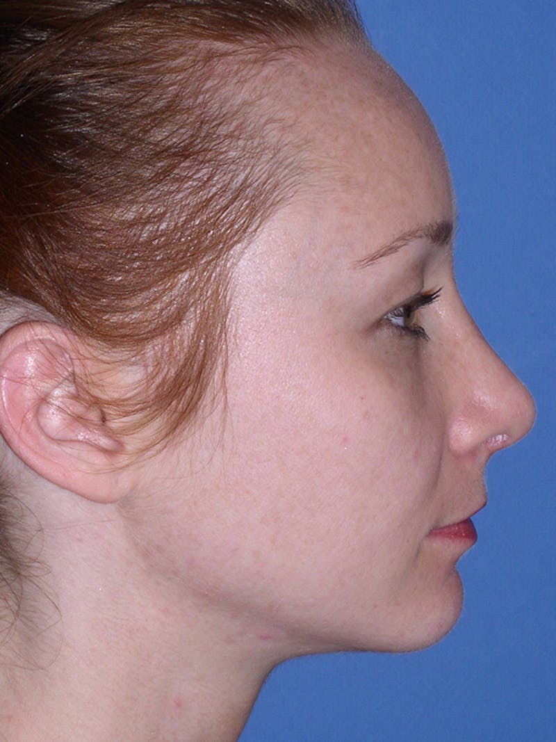 Rhinoplasty Before & After Gallery - Patient 179729367 - Image 6