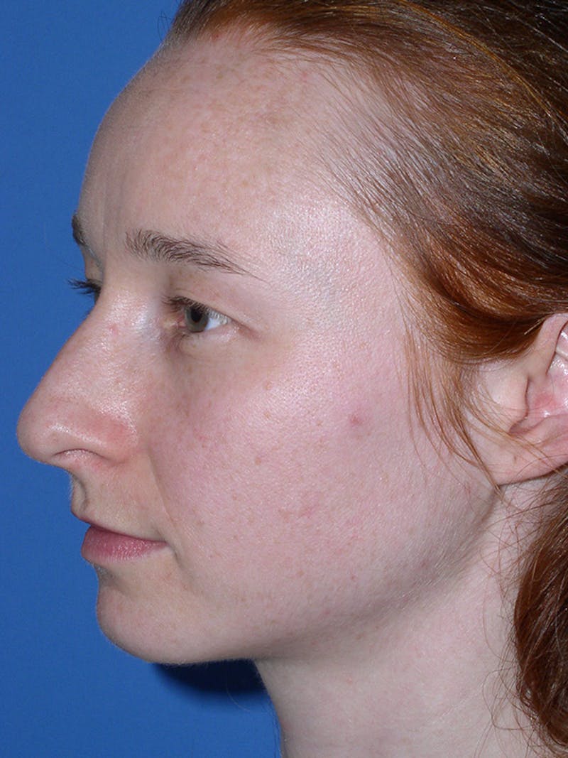 Rhinoplasty Before & After Gallery - Patient 179729367 - Image 7