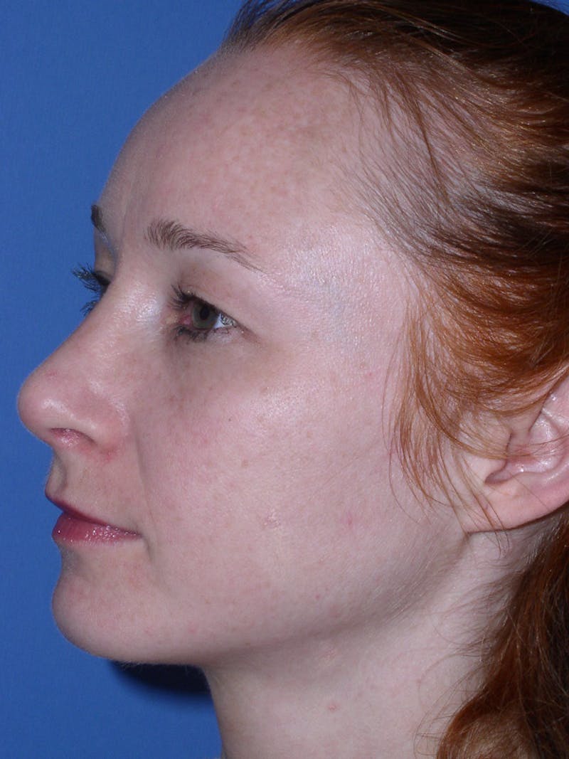 Rhinoplasty Before & After Gallery - Patient 179729367 - Image 8