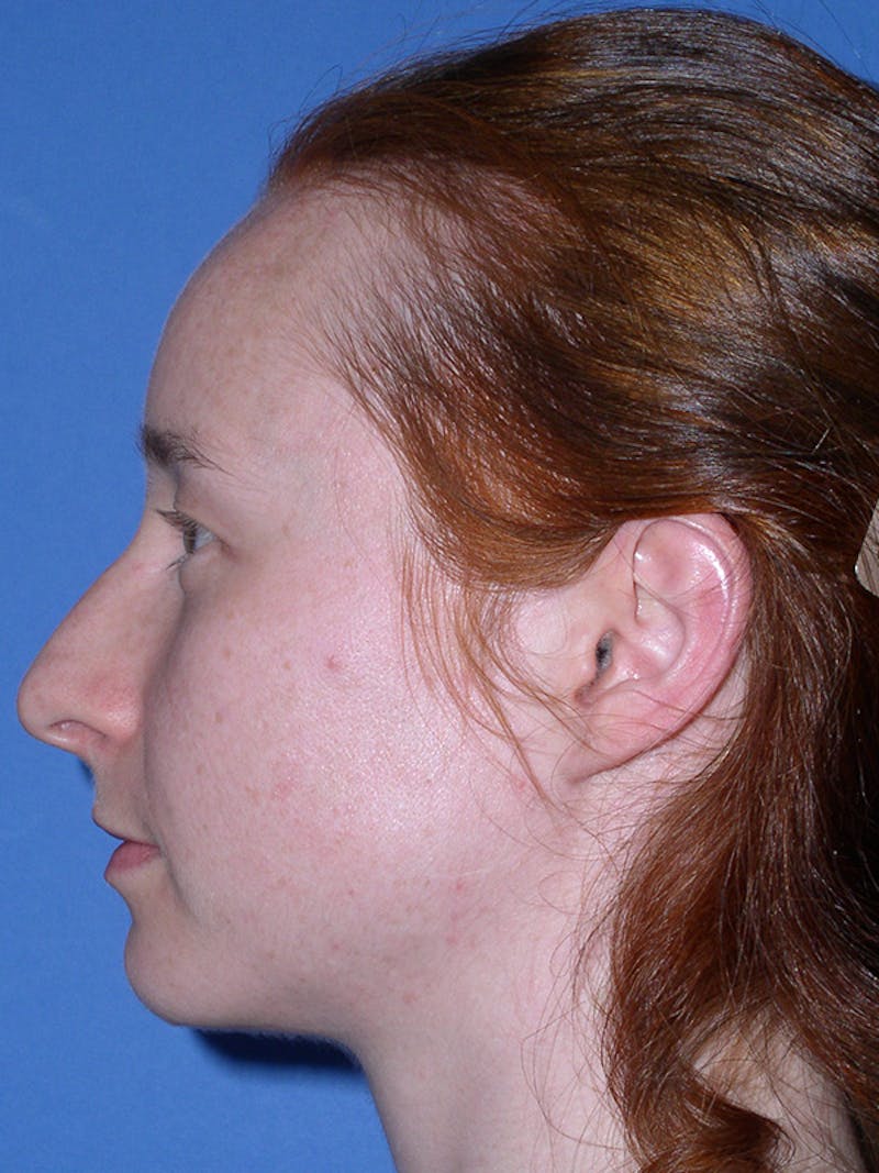 Rhinoplasty Before & After Gallery - Patient 179729367 - Image 9